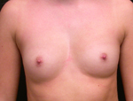 Patient # 23496 Before Photo # 1